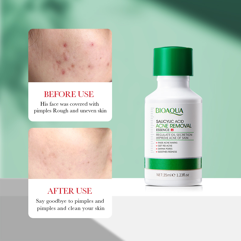 35 ml BIOAOUA Salicylsäure Ant – Tranexamic Acid Serum Bewertung und Preis
