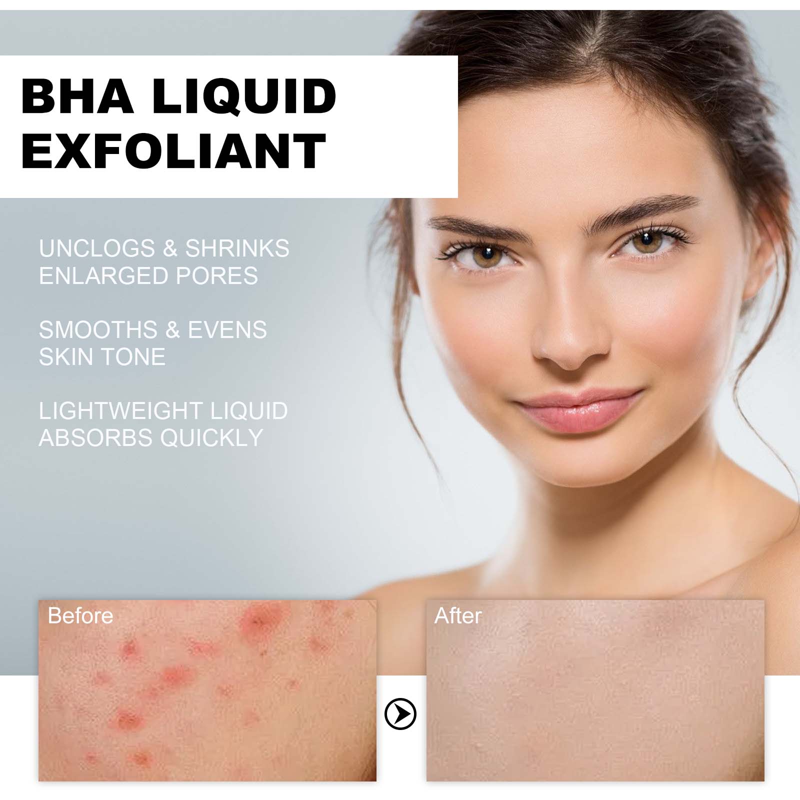 2% Salicylsäure Flüssiges Peel – Tranexamic Acid Serum Bewertung und Preis