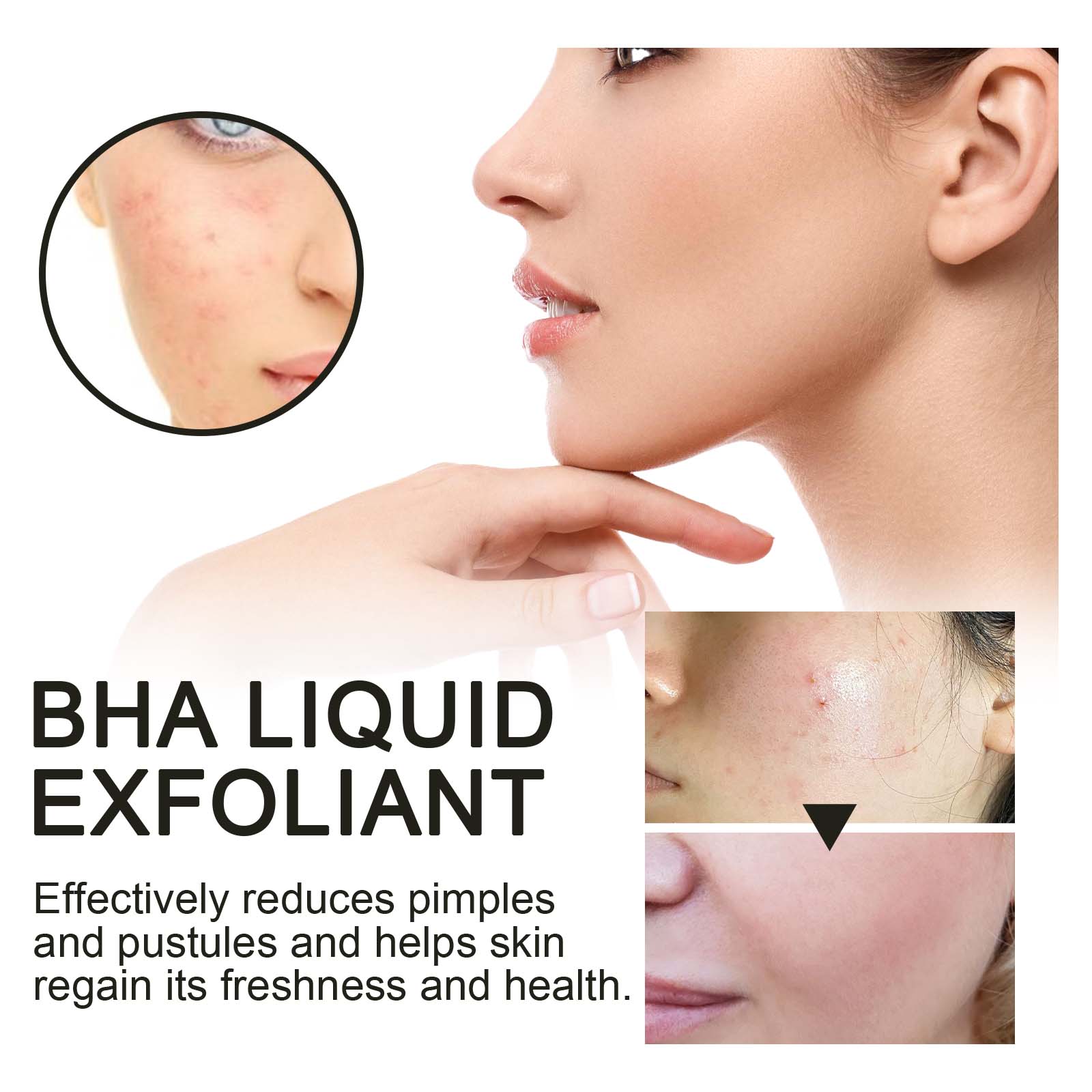 2% Salicylsäure Flüssiges Peel – Tranexamic Acid Serum Bewertung und Preis